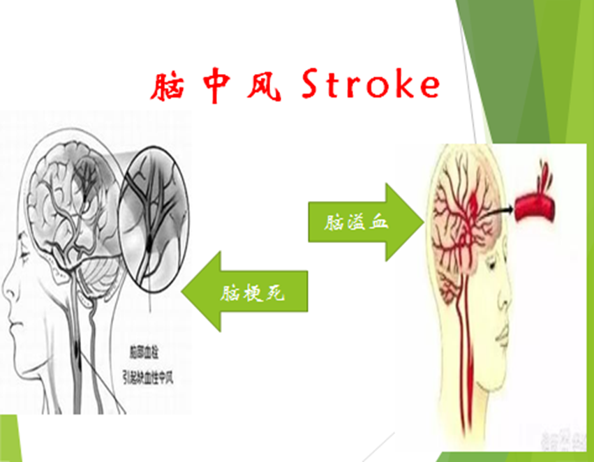脑中风